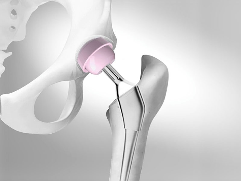 Orthopedic Implants