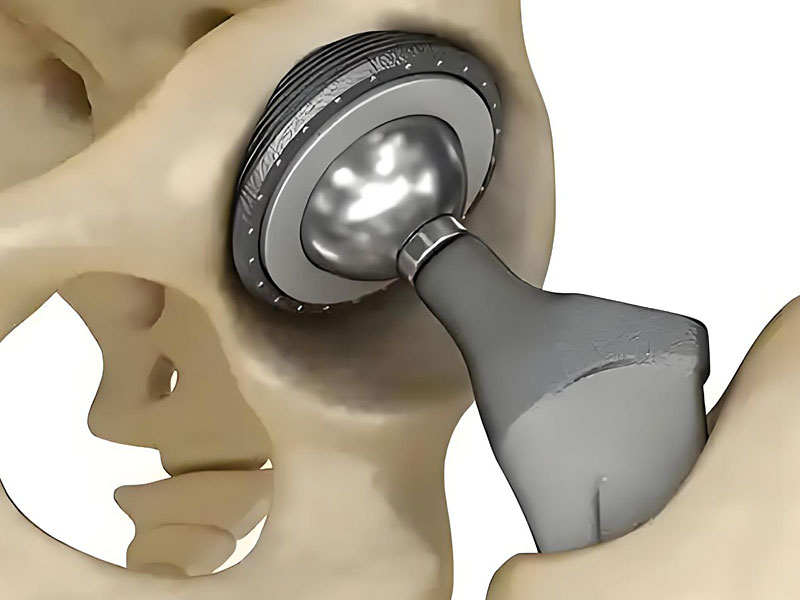 Medical Implant Titanium Plate